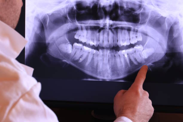 Best Emergency Dentist for Lost Fillings or Crowns in Asheville, NC