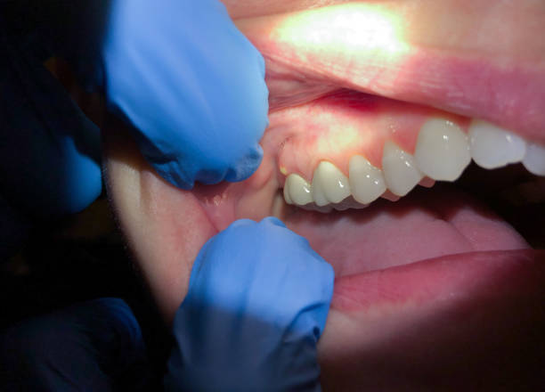 Best Emergency Dentist for Lost Fillings or Crowns in Asheville, NC
